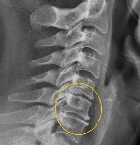 osteocondrosis cervical
